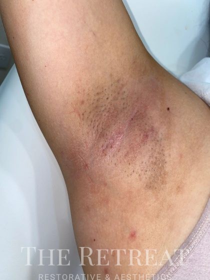 Underarm Before  After Photos of Laser Hair Removal  Milan Laser in York  PA